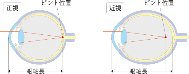 子供の近視進行（小児近視）について